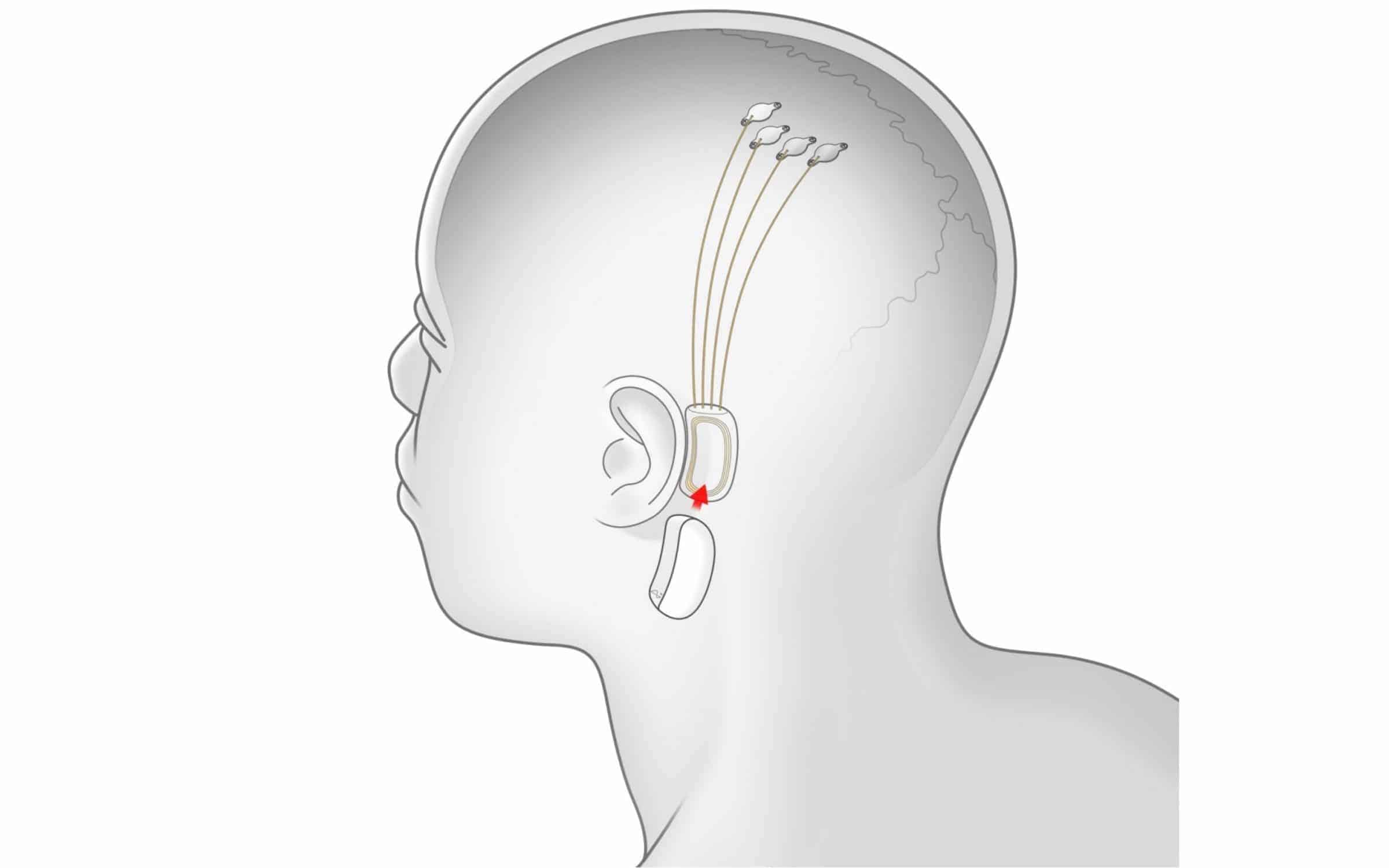 Neuralink N1 Sensor Intern Extern Bridge